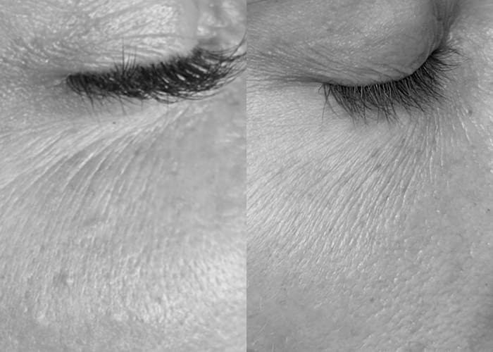 Rejuran before and after at Glow Cosmetique