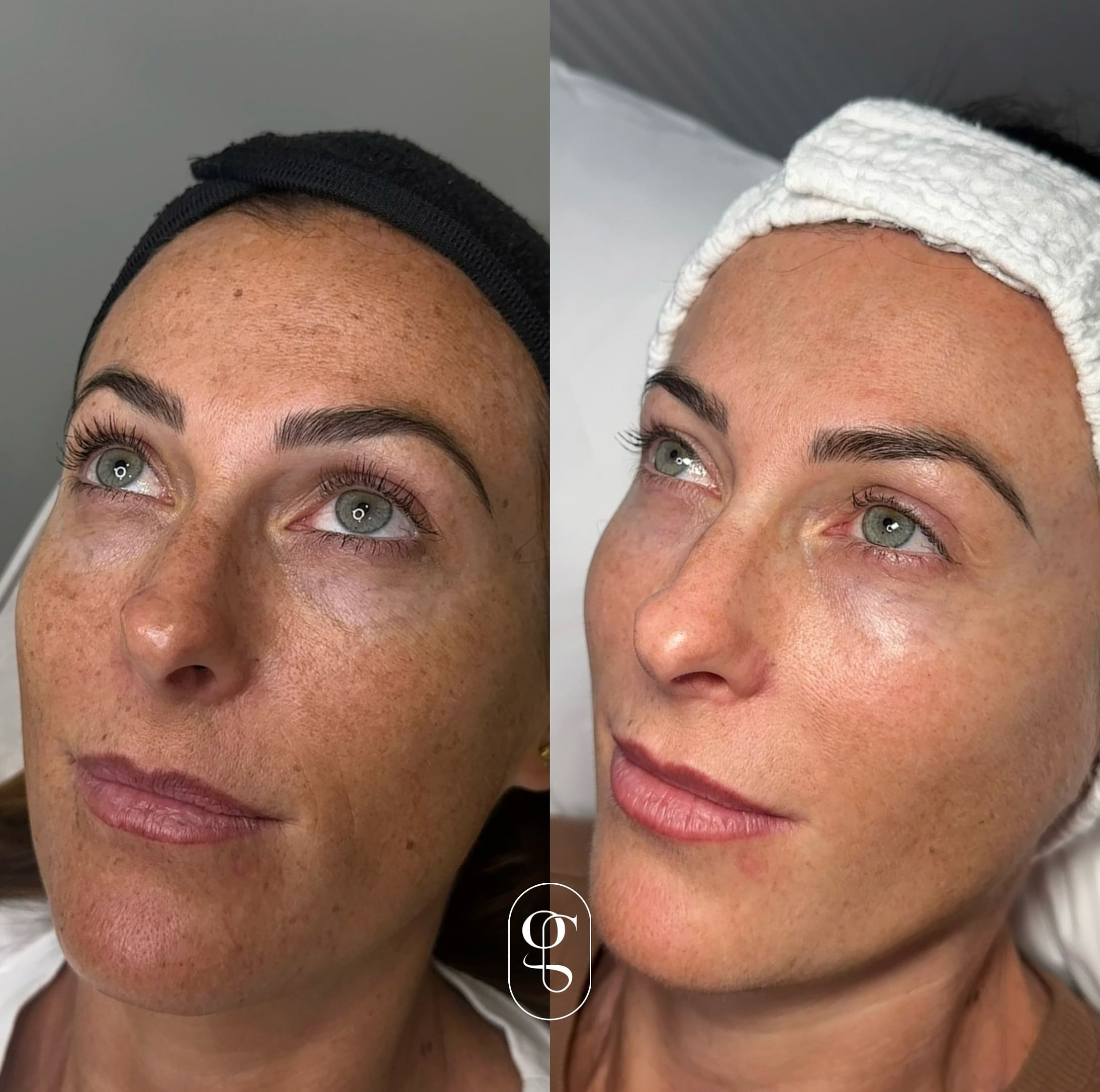 Skin cosmetic injectables laser resurfacing Melbourne skin clinic Melbourne anti aging clinic Melbourne