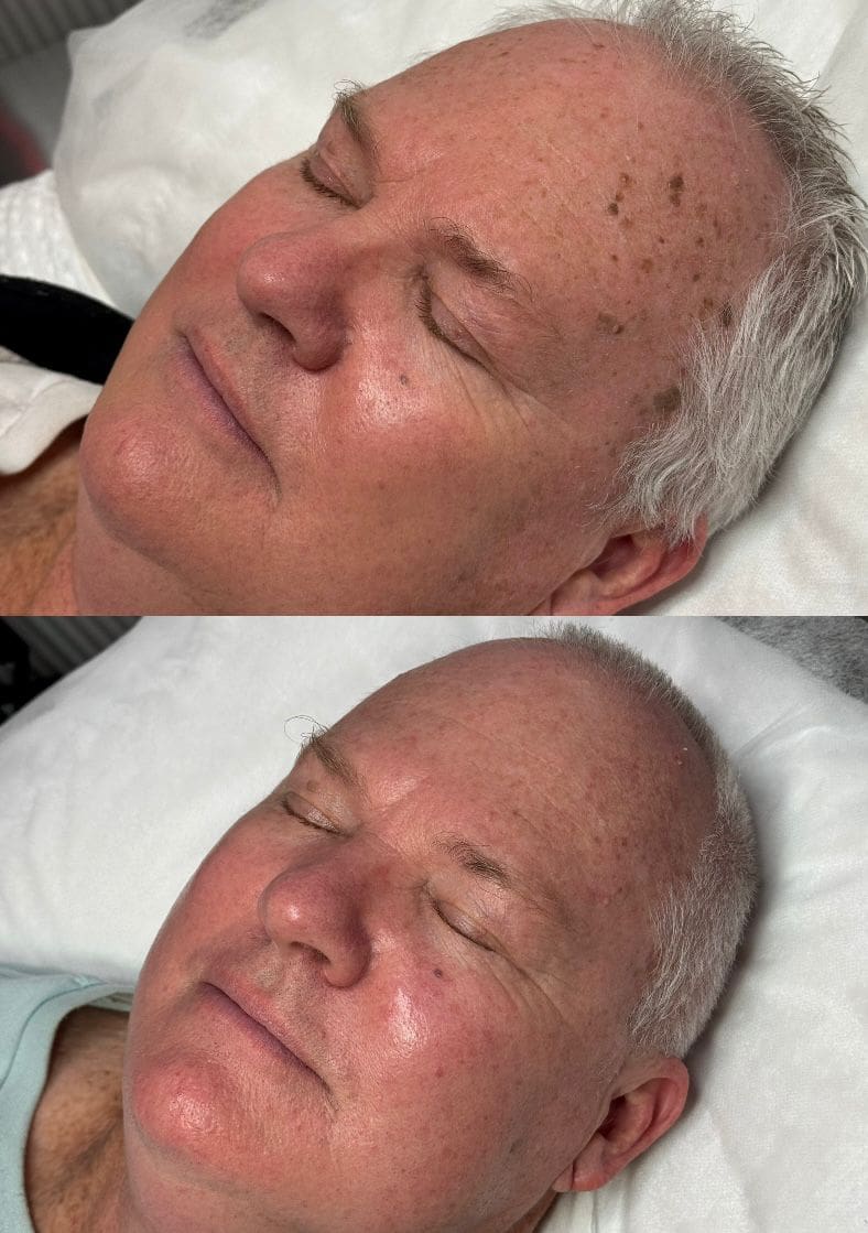 Man with brown lesions on his face