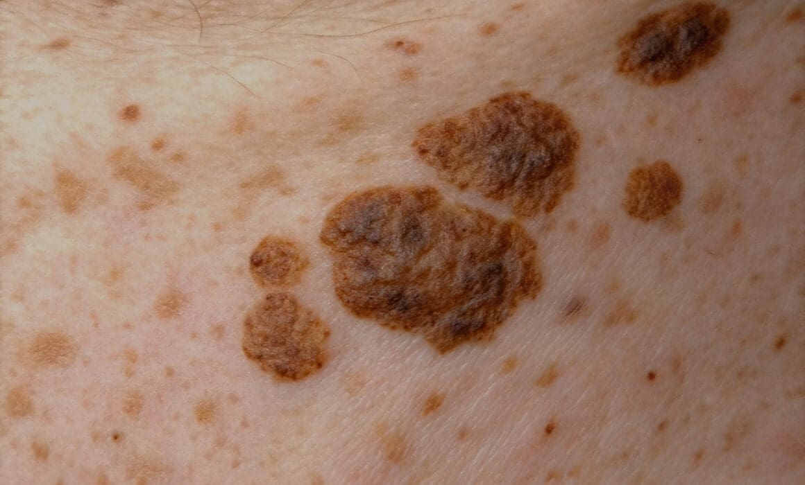 Close-up view of a benign seborrhoeic keratosis with scaly, wart-like appearance