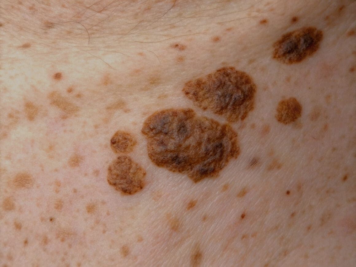 Close-up view of a benign seborrhoeic keratosis with scaly, wart-like appearance