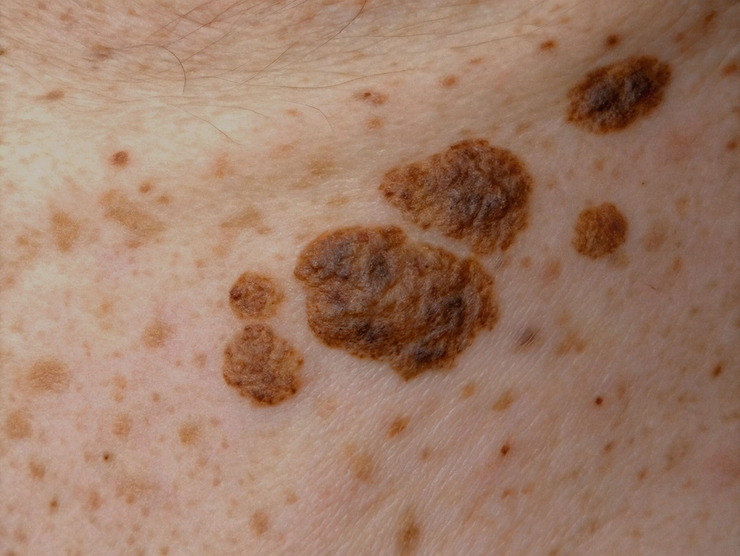 Close-up view of a benign seborrhoeic keratosis with scaly, wart-like appearance
