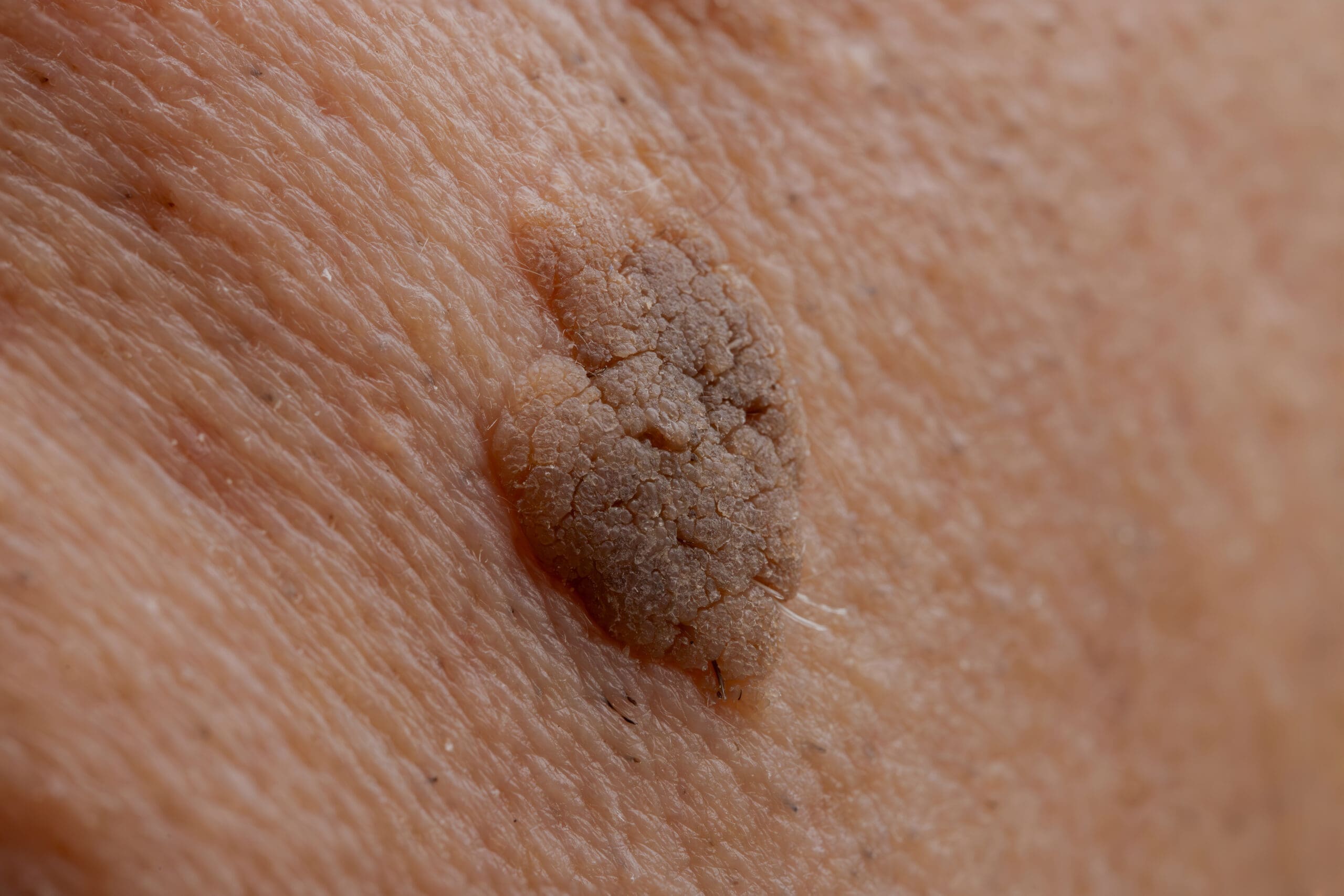 Seb k seborrhoeic keratosis removal seborrhoeic keratosis assessment treatment for seborrhoeic keratosis skin lesion consultation raised brown spots on skin