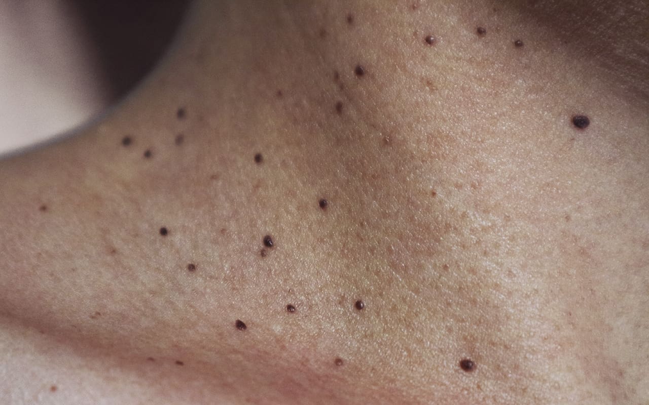 Close-up view of a benign seborrhoeic keratosis with scaly, wart-like appearance